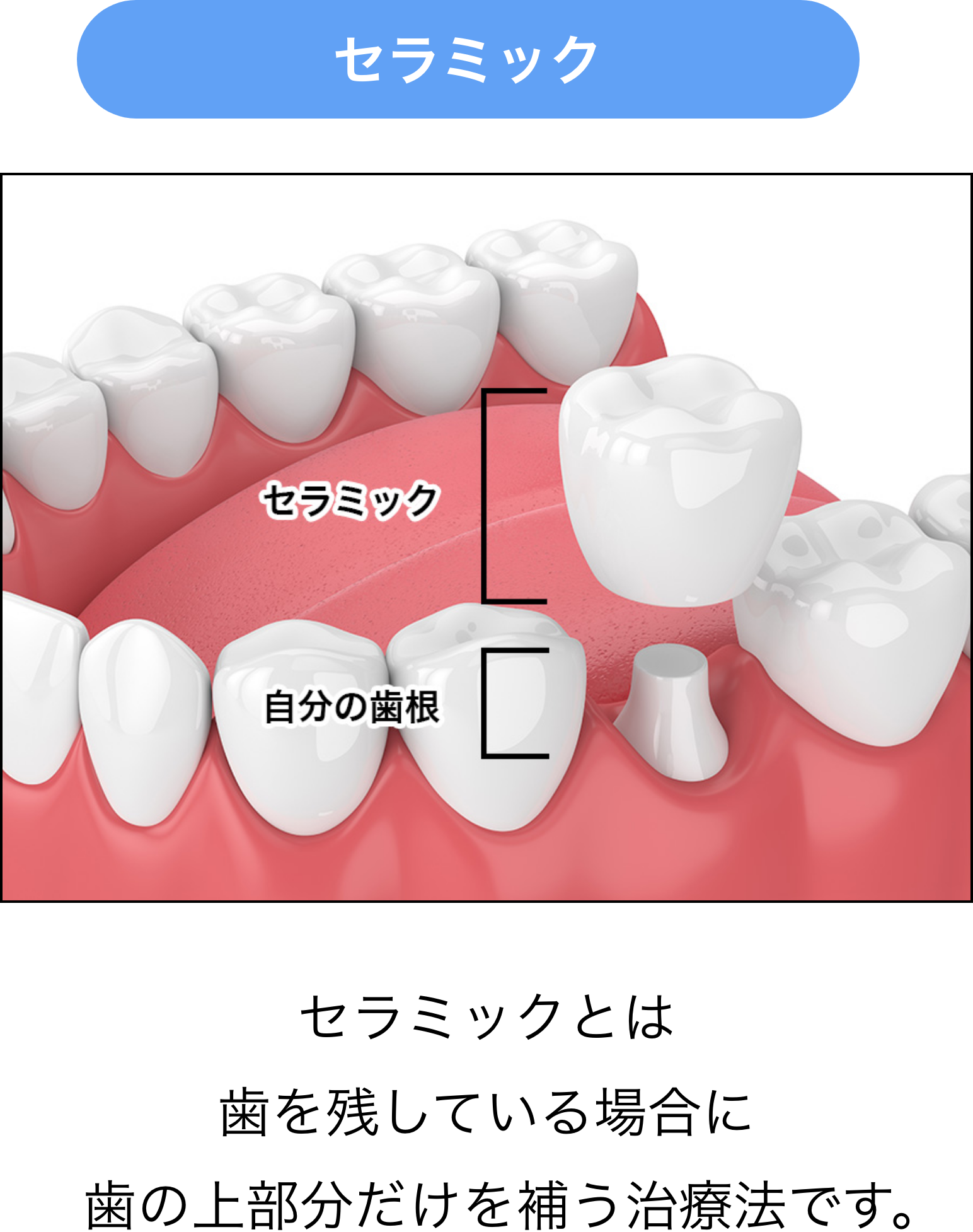 セラミックとは歯を残している場合に歯の上部分だけを補う治療法です。