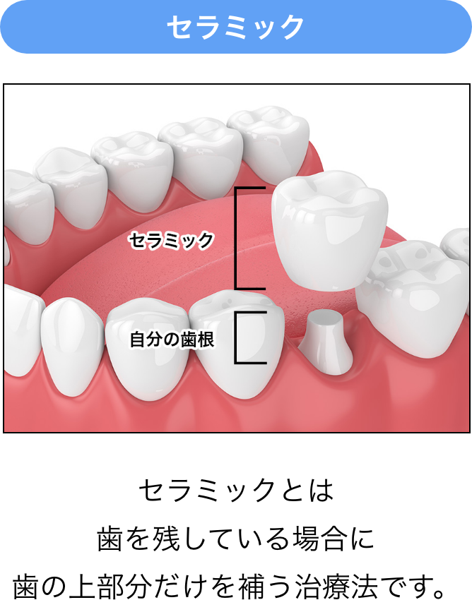 セラミックとは歯を残している場合に歯の上部分だけを補う治療法です。