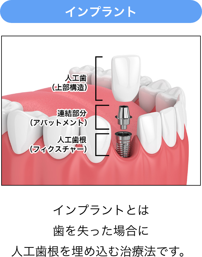 インプラントとは歯を失った場合に人工歯根を埋め込む治療法です。